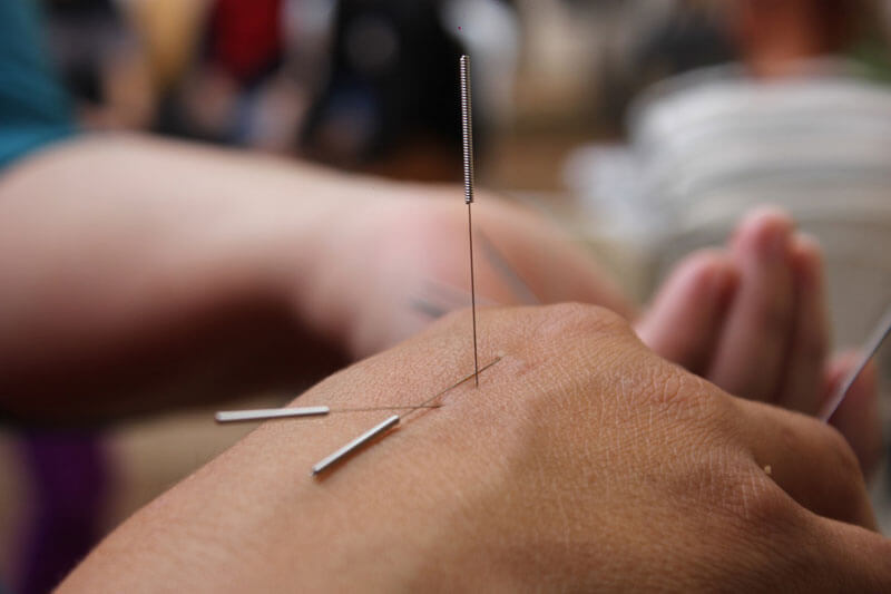 Closeup of hand with a couple acupuncture needles in it