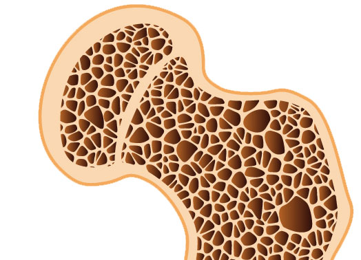 Diagram of a bone with osteoporosis